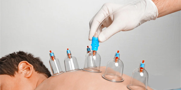Cupping Therapy